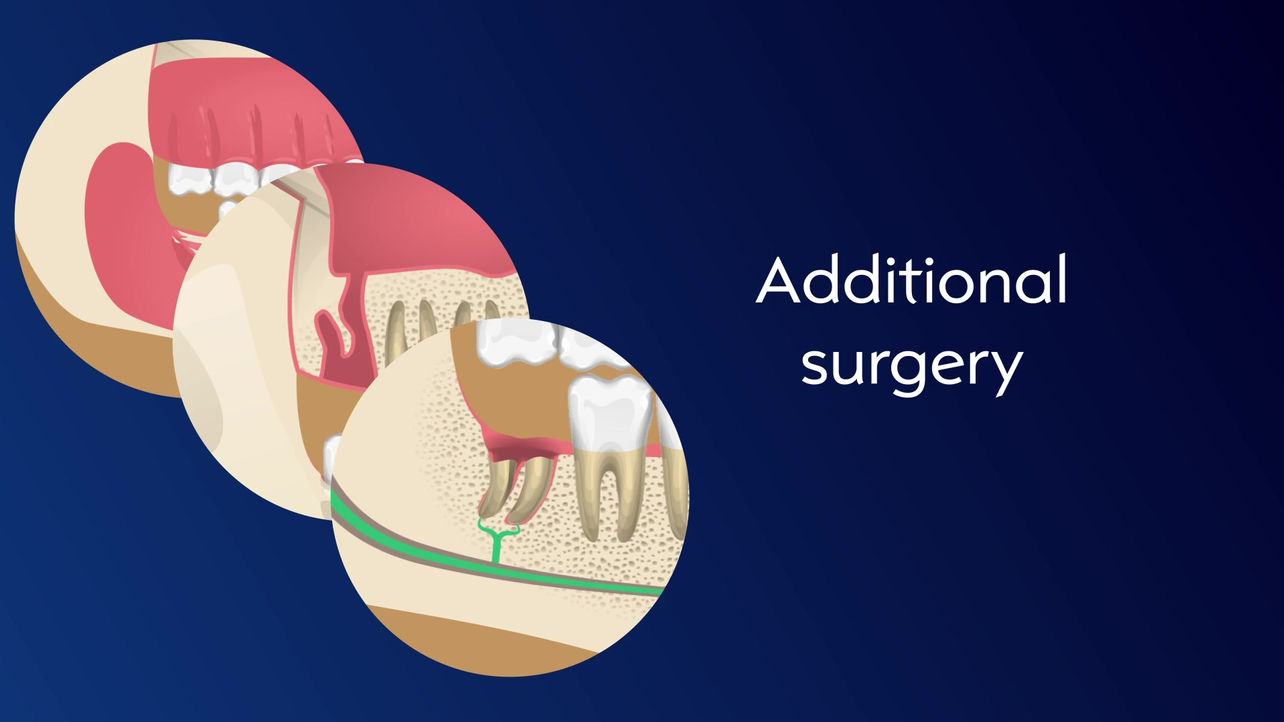 Wisdom Tooth Surgery